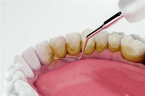 Tips for Removing Tartar Buildup From Your Teeth