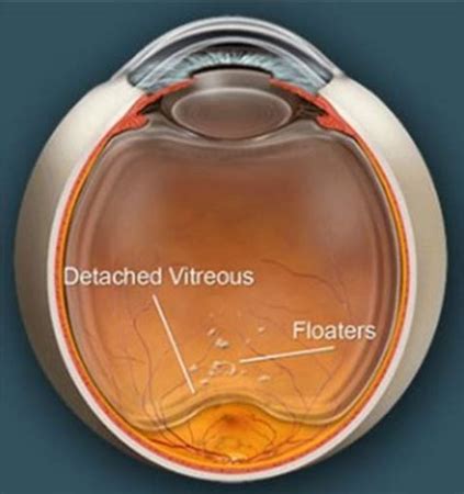 Posterior Vitreous Detachment Floaters