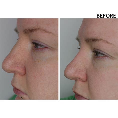Bump On Nose