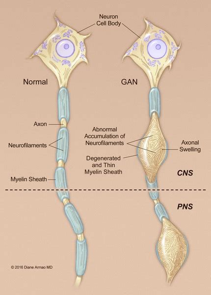 Causes Of Motor Axonal Neuropathy | Webmotor.org