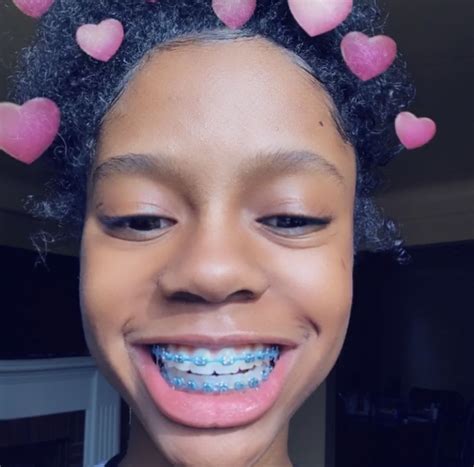 colors  braces  dark skin gif