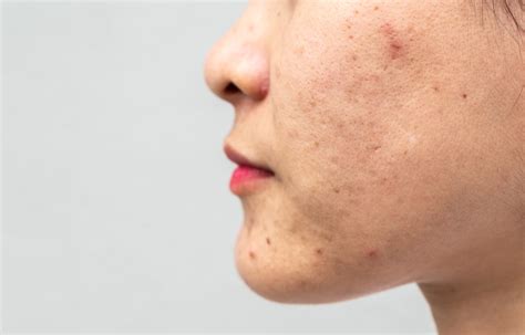 rid  clogged pores   treatment  prevention