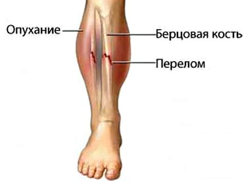 Малоберцовая кость: анатомия и строение, её головки, боли и лечение