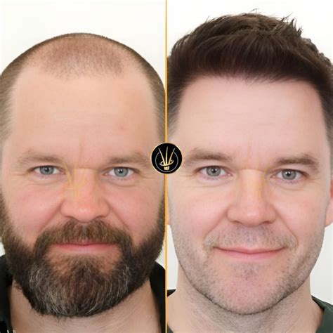 real  hair hair transplant center  turkey turkeys  hair