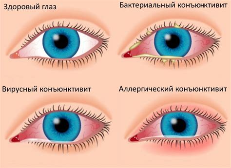Конъюнктивит - лечение болезни. Симптомы и профилактика заболевания ...