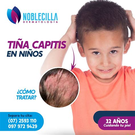 ¿La tiña capitis en... - Noblecilla Dermatología Integral | Facebook
