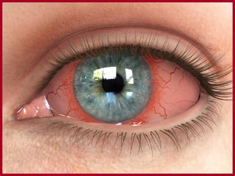 Dry Eye Awareness Month: Facts about Dry Eye Syndrome