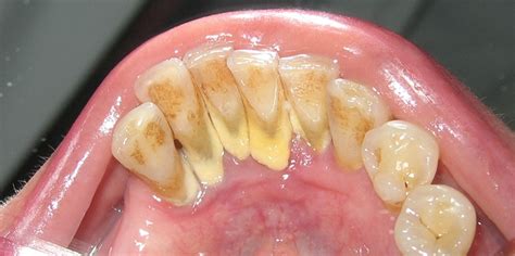 7 Astounding Facts About Plaque And Calculus For A Brighter Smile