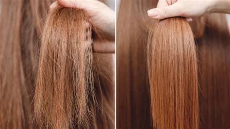Laser Capilar Antes E Depois - Laser capilar antes e depois: veja os principais cuidados!