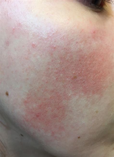 keratosis pilaris rubra faceii - Captions for Pictures