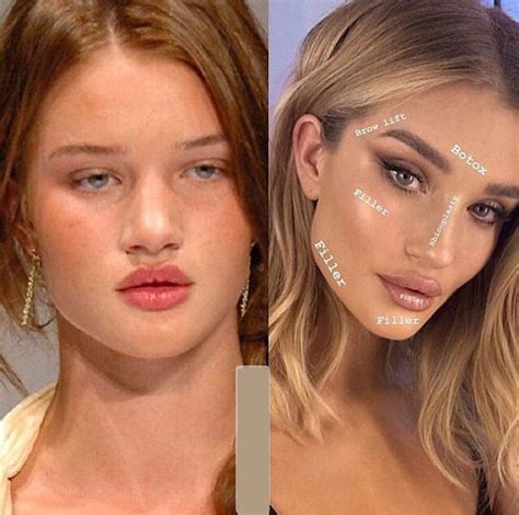 Что Такое Филлеры Для Лица Фото — Фото