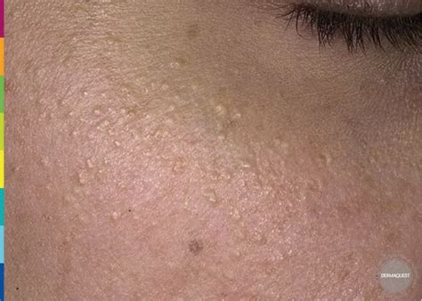 DERMAQUEST » Фолликулярный гиперкератоз| Статьи | Отзывы | Купить