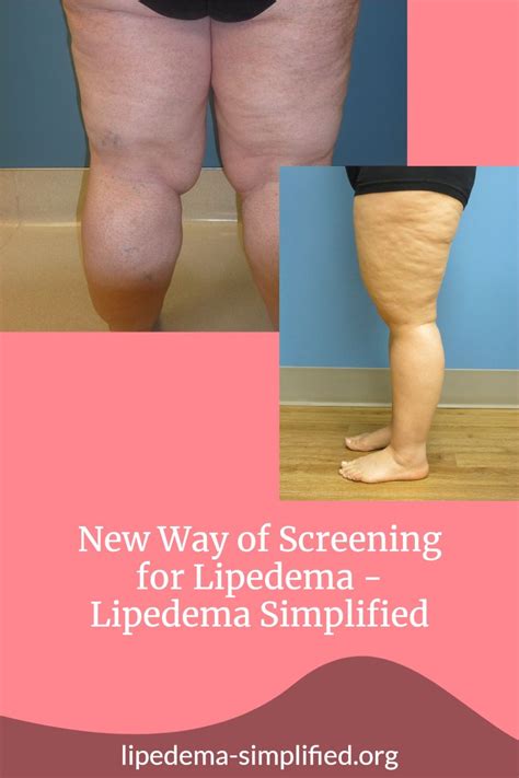 Innovative Screening Method for Lipedema