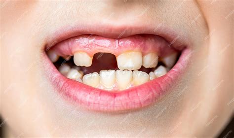 Premium Photo | Child bad teeth boy kid lost front tooth toothache ...