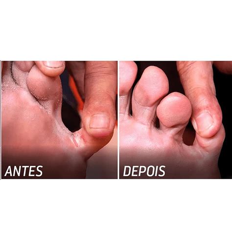 Lakesia Antes E Depois - Lakesia Pro creme dermatológico antifúngico 20gr - FarmaViver