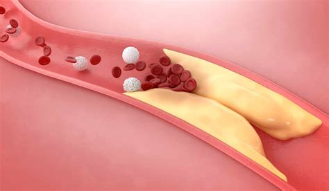 Atherosclerosis: What Is, Symptoms, Causes, Complications, and Diet