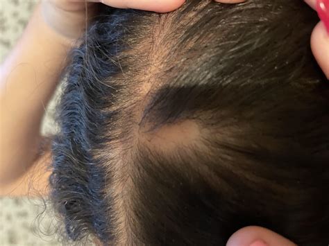 Traction Alopecia? : r/braids