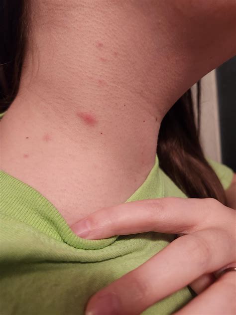 brown recluse spider bite time lapse 19