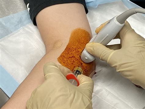 Ulnar Collateral Ligament Rehabilitation