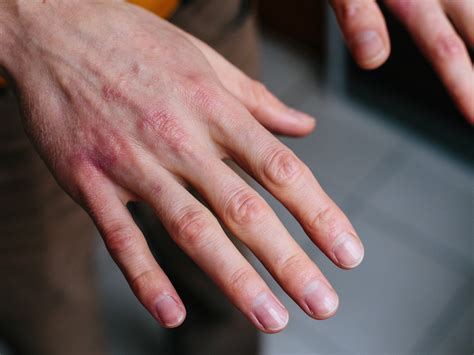 Best Natural Treatment For Sore, Dry, Cracked Hands – Balmonds