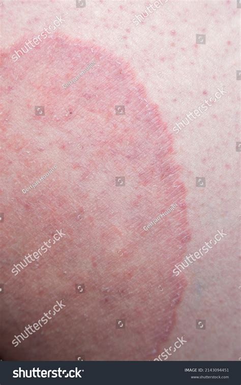 Tinea Cruris Known Jock Itch Common ภาพสต็อก 2143094451 | Shutterstock