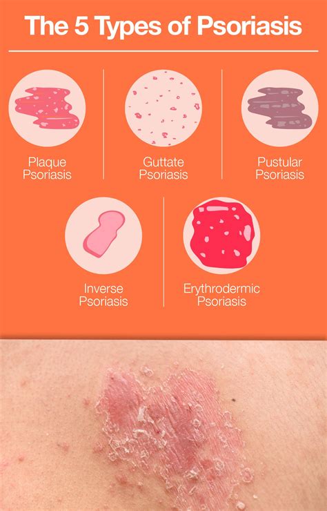 guttate psoriasis pictures  symptoms