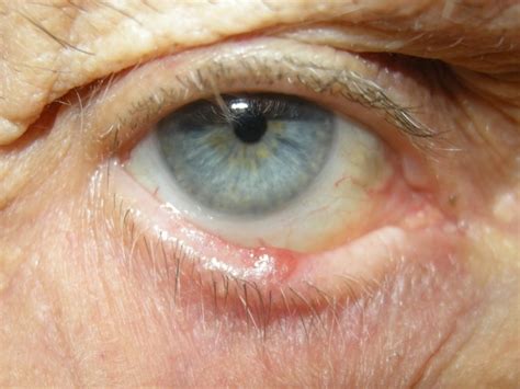 Early Basal Cell Carcinoma Eyelid