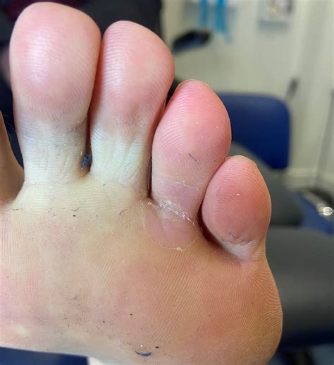 Cryotherapy | verrucae treatment options | Treatments | Chiropody.co.uk