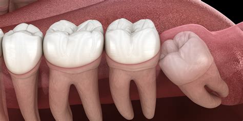 Impacted Teeth - Eastern Dental