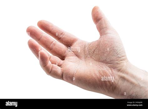 image of the mens hand showing skin disease isolated on white background Stock Photo - Alamy