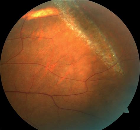 Snail-Track Degeneration - RetinaRA