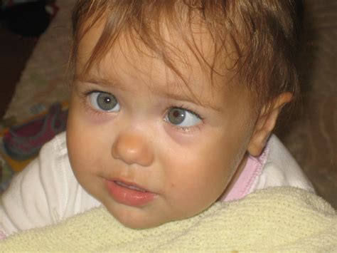 Crossed Eyes Neonatal at Maya Hurley blog