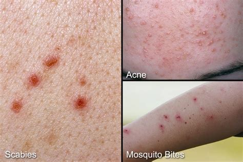 scabies pictures  rash mites symptoms treatment