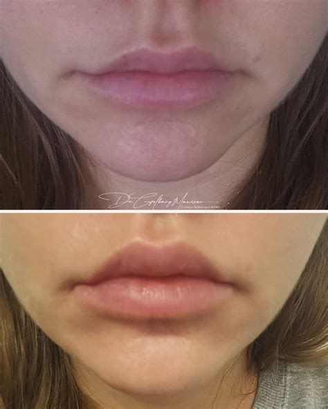Botox Lip Flip in Montreal – Clinique Esthétique HoMa
