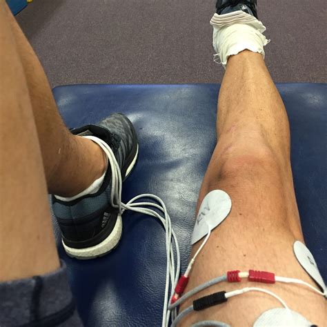 My Meniscus Transplant
