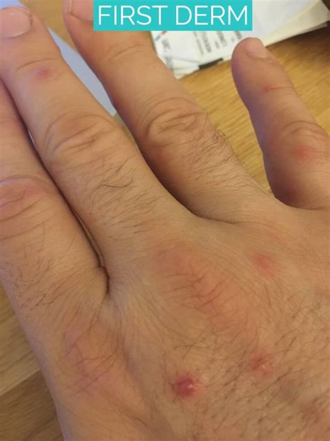 Stages of Hand, Foot, and Mouth Disease in Adults - | Hand foot and mouth, Disease, Mouth