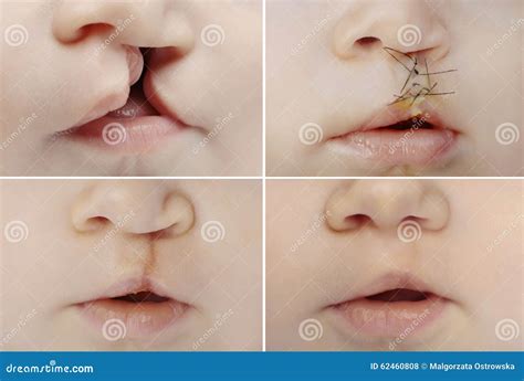 Lip and Palate Cleft before and after Surgery Stock Photo - Image of