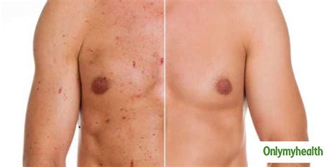 Chest Acne