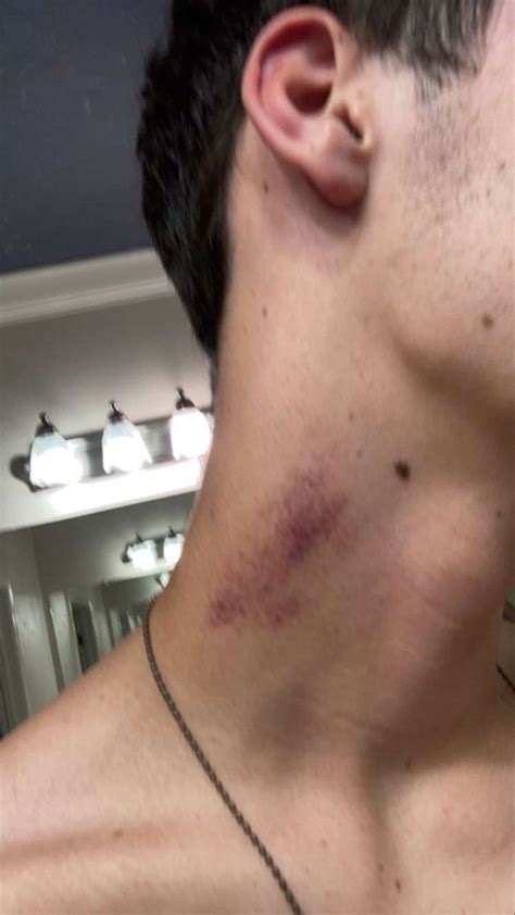 Ur mom | Hicks on neck, Hickies neck aesthetic guy, Neck bite boyfriend