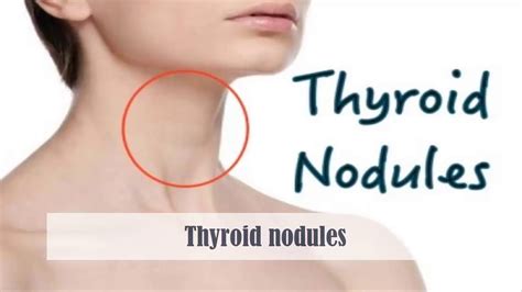 solitary thyroid nodule  symptoms diagnosis treatment prognosis