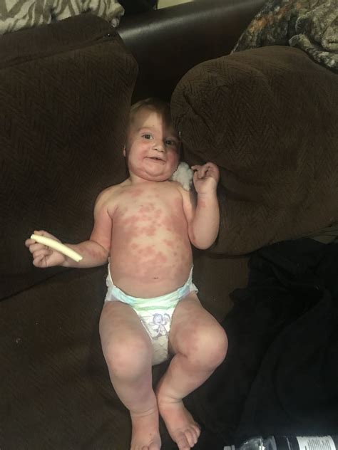Sickness Amoxicillin