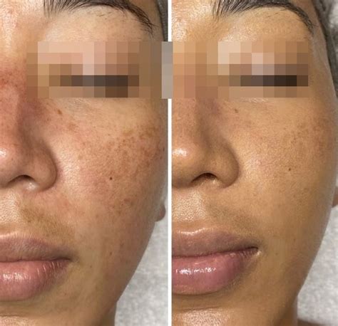 Ácido Retinoico Hidroquinona Antes E Depois - Hidroquinona Antes E Depois