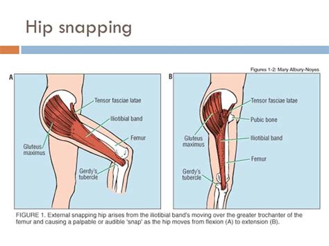 Snapping Hip - Mississauga Chiropractor and Physiotherapy Clinic - FREE ...