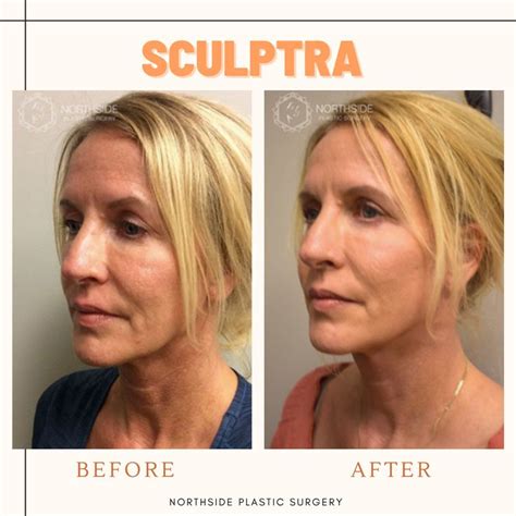 face lift  botox  botox placement sculptra