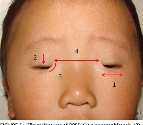 Blepharophimosis Ptosis Epicanthus Inversus Syndrome Or Bpes