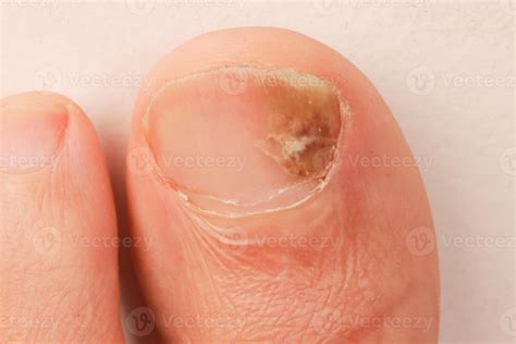 Man with a bruised and infected big toe on his left foot 70912380 Stock