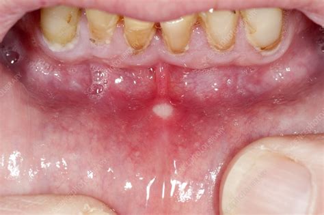 aphthous ulcer   mouth stock image  science photo