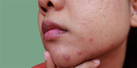 What Causes Chin Acne and How to Treat It, According to Dermatologists ...