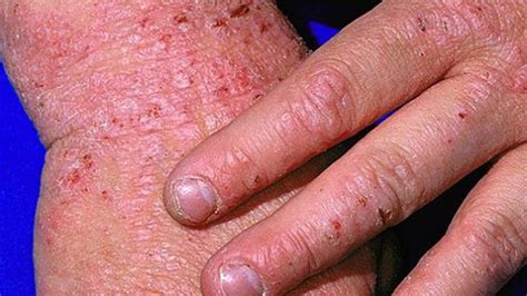 Types of Eczema: Identification, Pictures, and More