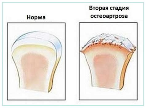 Остеоартроз коленного сустава 2 степени: лечение, причины, симптомы